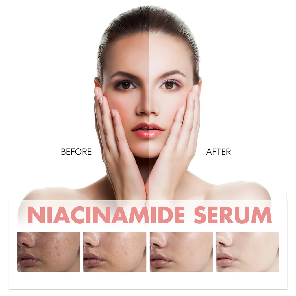 HOYGI pêche Niacinamide sérum pour le visage fondu mélanine tache foncée rétrécit les Pores lisse éclaircir la peau hydratant rajeunissement soins de la peau